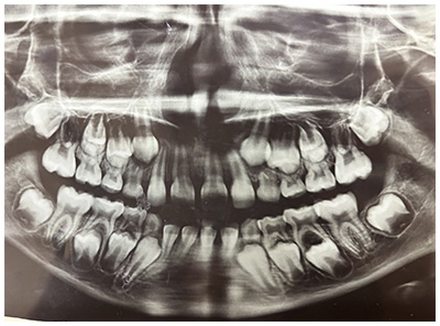 X-Ray of Teeth
