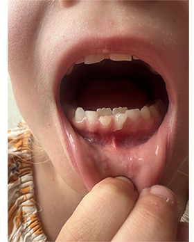 Retained Teeth